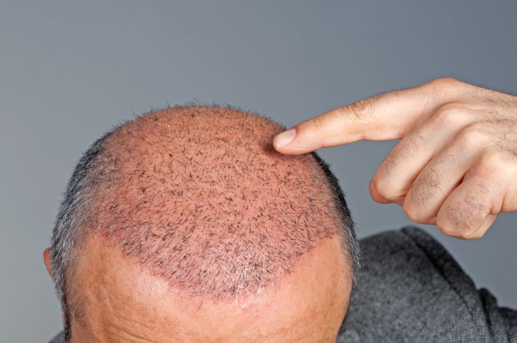 The Power of Hair Transplant
